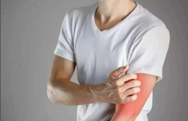 甲醛超標引起皮膚過敏